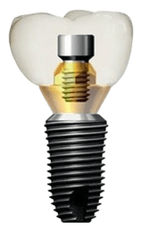 Dentium импланты